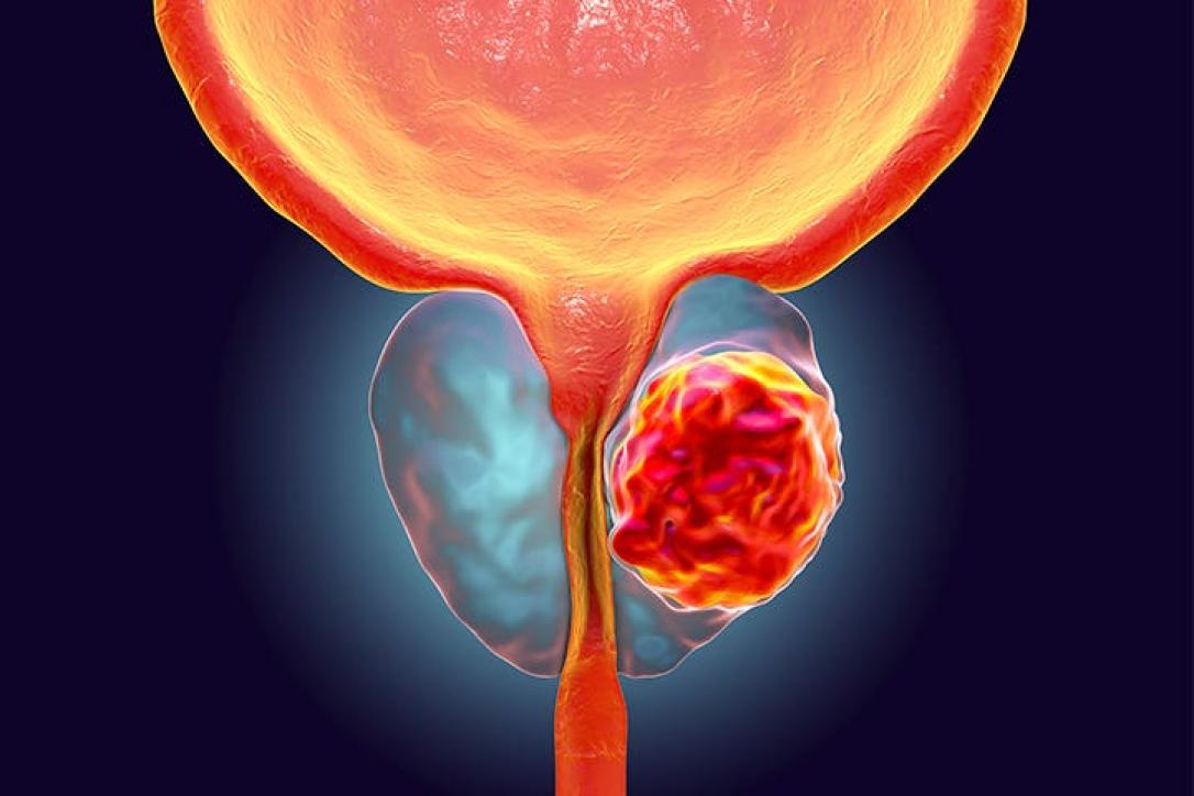 Prostat Kanseri Nedir? Belirtileri, Tanısı ve Tedavisi
